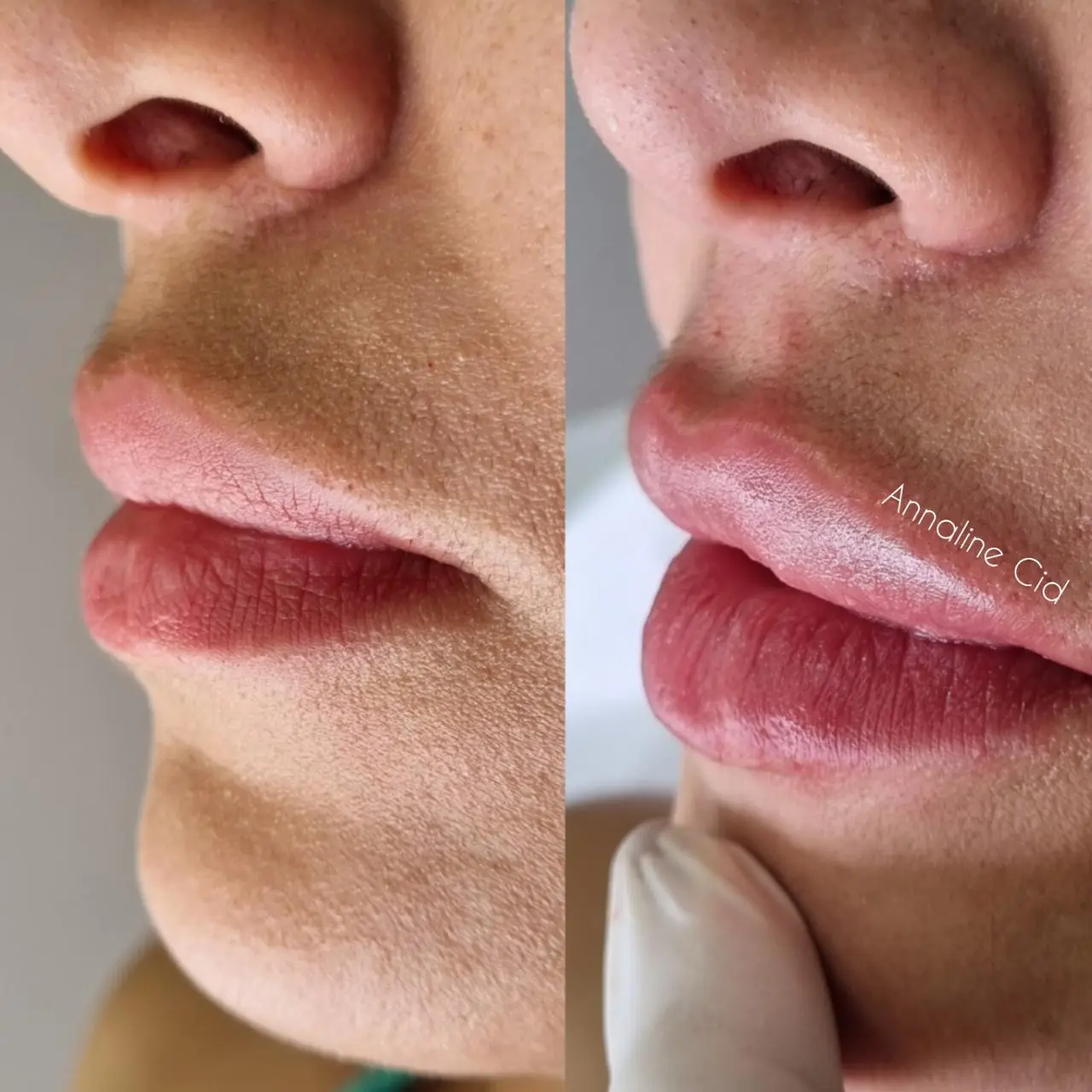 Antes e depois (autorizado)