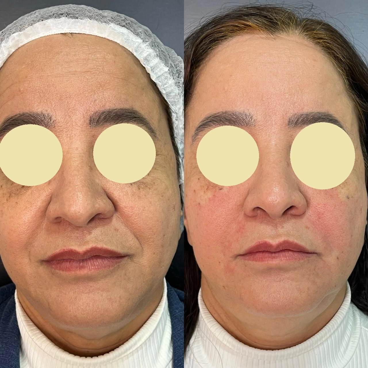 Antes e depois (autorizado)