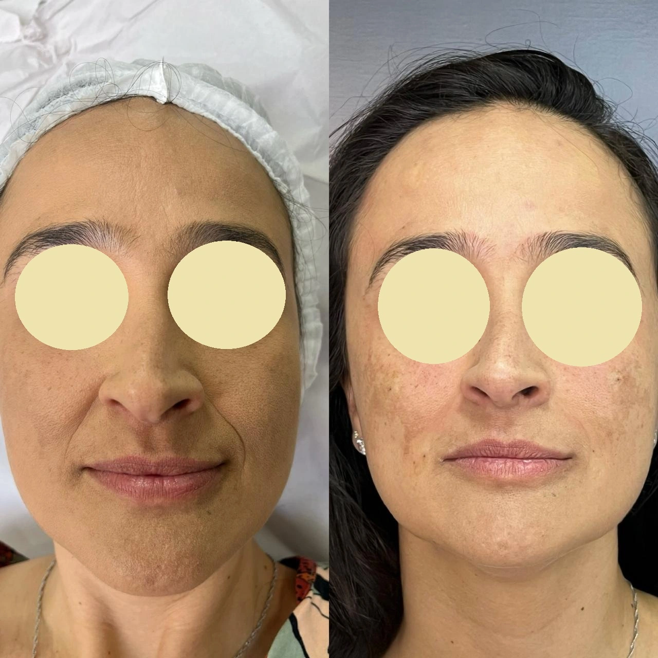 Antes e depois (autorizado)